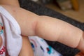 Prickly heat. Close-up of the folds of the hand of a newborn baby with red skin.