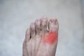 Foot of pateint skin joint arthritis