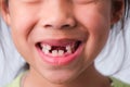 Close-up of a girl with broken upper baby teeth and first permanent teeth. Friendly little girl showing her broken teeth isolated