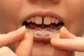 Close up of a girl holding put on invisible braces. Orthodontic dental braces teeth straighteners. Gap between front teeth Royalty Free Stock Photo