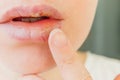 Close up of girl lips affected by herpes. Treatment of herpes infection and virus. Part of young woman face with finger touching