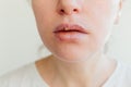 Close up of girl lips affected by herpes. Treatment of herpes infection and virus. Part of young woman face, lips with