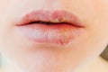 Close up of girl lips affected by herpes. Treatment of herpes infection and virus. Part of young woman face, lips with herpes Royalty Free Stock Photo