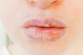 Close up of girl lips affected by herpes. Treatment of herpes infection and virus. Part of young woman face, lips with herpes