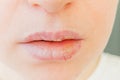 Close up of girl lips affected by herpes. Treatment of herpes infection and virus. Part of young woman face, lips with Royalty Free Stock Photo