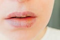 Close up of girl lips affected by herpes. Treatment of herpes infection and virus. Part of young woman face, lips with herpes