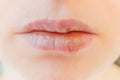 Close up of girl lips affected by herpes. Treatment of herpes infection and virus. Part of young woman face, lips with herpes Royalty Free Stock Photo
