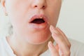 Close up of girl lips affected by herpes. Treatment of herpes infection and virus. Part of young woman face with finger touching Royalty Free Stock Photo