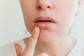 Close up of girl lips affected by herpes. Treatment of herpes infection and virus. Part of young woman face with finger touching Royalty Free Stock Photo