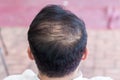 Close up hair loss, thinning hair and scalp issue. hair loss treatment.head with loss symptoms. Bald treatment. Royalty Free Stock Photo