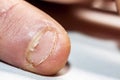 Close up of hand with bitten finger and fingernails.