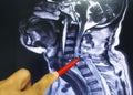 Close up hand doctor holding a red pen tells the patient the examination of the mri c-spine. Royalty Free Stock Photo