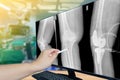 Close up hand Doctor point Image X-ray knee replacement with blurred background of surgical team performing surgery in operating Royalty Free Stock Photo