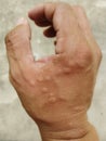 Close up hand human after Allergic rash from insect bites Bees, wasps, ants, mosquitoes .Medical image concept.