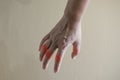 Close up hand rheumatoid arthritis pateint. Royalty Free Stock Photo