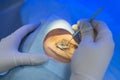 A close-up of the hands of an ophthalmologist surgeon looking through a microscope using microsurgical instruments for eye surgery