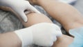 Close-up hands of phlebologist in gloves disinfect leg of patient with varicose veins before sclerotherapy procedure