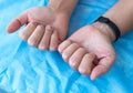 Close-up of hands with very bad skin condition, cracked skin on hands on a blue background. Treatment of dermatitis and Royalty Free Stock Photo