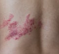 Close up on herpes zoster on the back Royalty Free Stock Photo