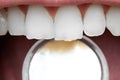 Close-up of human front teeth Royalty Free Stock Photo