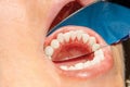 Close-up of human mouth teeth after professional whitening in th