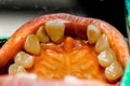 Close up human patient open mouth showing caries teeth decay with gingivitis