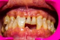 Close up human patient open mouth showing caries teeth decay with gingivitis Royalty Free Stock Photo