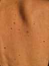 Close-up of human skin with multiple moles and pigmented nevi on the back. Royalty Free Stock Photo