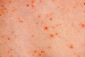 Close up image of a little boy`s body suffering severe urticaria, nettle rash also called hives Royalty Free Stock Photo