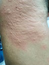 Close up image of man\'s body suffering irritation and allergic reactions.