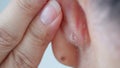 Psoriasis on ear