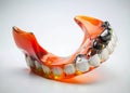 Damaged Partial Denture Examining the Effects of Wear and Tear on a Plastic Dental Prosthesis Against a Clean Royalty Free Stock Photo