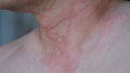 Close up image of skin texture suffering severe urticaria or hives