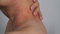 Close up image of skin texture suffering severe urticaria or hives