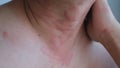 Close up image of skin texture suffering severe urticaria or hives