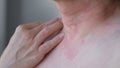 Close up image of skin texture suffering severe urticaria or hives