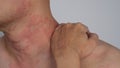 Close up image of skin texture suffering severe urticaria or hives