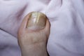 A close-up of the ingrown nail of a person with a fungal infection. The concept of nail care and treatment of their Royalty Free Stock Photo