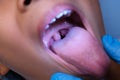 Close-up inside the oral cavity of a healthy child with beautiful rows of baby teeth. Young girl opens mouth revealing upper and