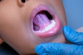 Close-up inside the oral cavity of a healthy child with beautiful rows of baby teeth. Young girl opens mouth revealing upper and