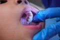 Close-up inside the oral cavity of a healthy child with beautiful rows of baby teeth. Young girl opens mouth revealing upper and