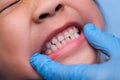 Close-up inside the oral cavity of a healthy child with beautiful rows of baby teeth. Young girl opens mouth revealing upper and