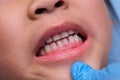 Close-up inside the oral cavity of a healthy child with beautiful rows of baby teeth. Young girl opens mouth revealing upper and