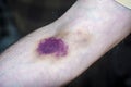 Close-up of a large bruise on the skin after an unqualified injection