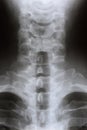 Lateral x-ray of the neck and cervical spine of a person Royalty Free Stock Photo