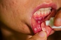 Close - up on the lip with aphthous stomatitis applying antibacterial cream Royalty Free Stock Photo