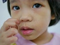 Close up of little Asian baby girl scratching on her allergic face, as it got rashes making her facial skin dry, and itchy