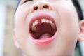 Close up of lost teeth in the mouth of young Asia boy 6 years old