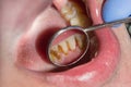 Close-up of macro dental calculus and dental plaque. Oral hygiene in dentistry