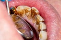 Close-up of macro dental calculus and dental plaque. Oral hygiene in dentistry
